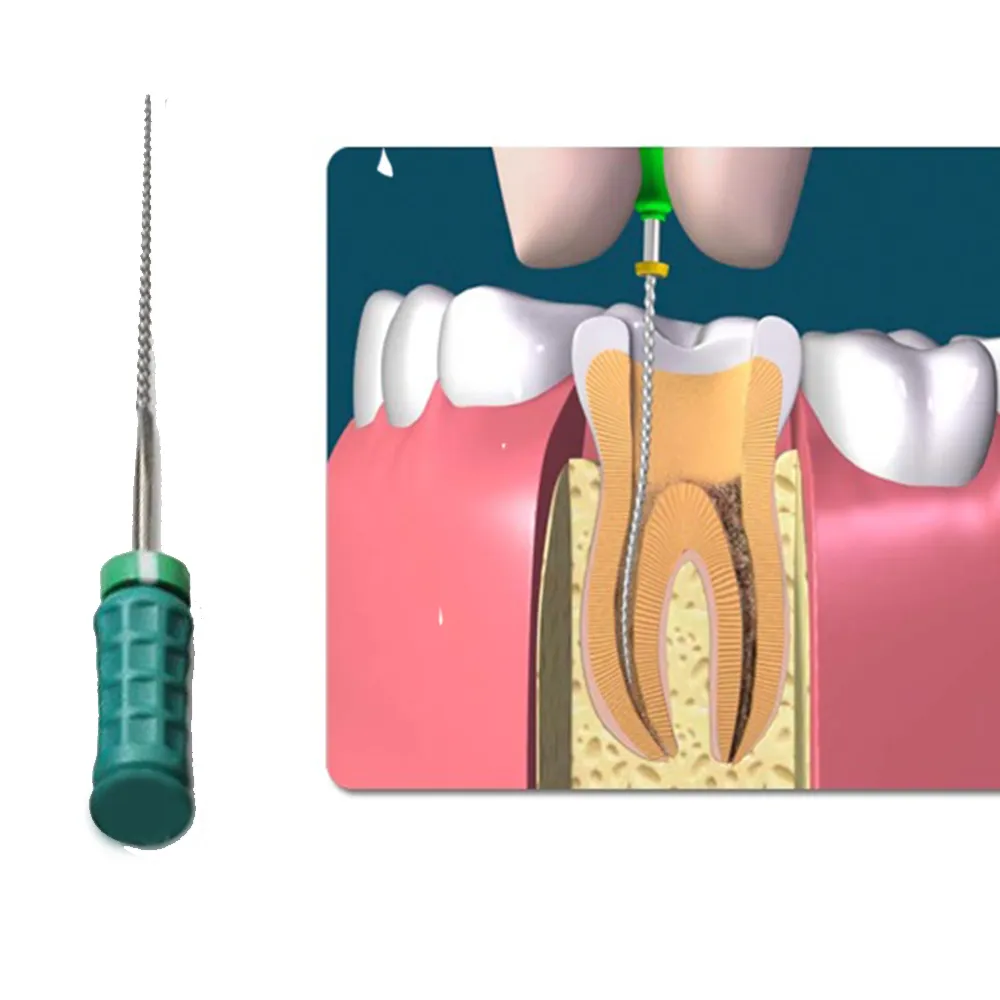 K-files in Endodontics - Choosing the Right K-Files for Success