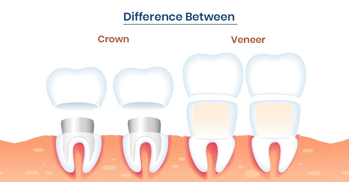 Veneers vs Crowns: What's the Difference?