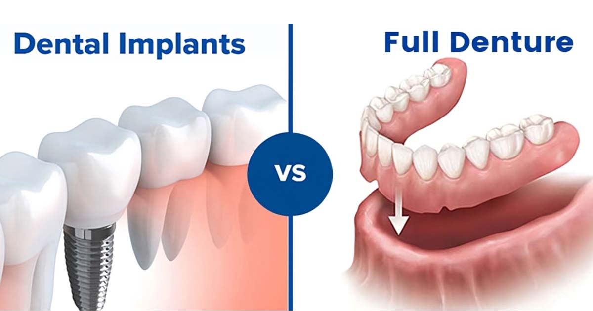 Dentures vs Implants - What to choose, Advantages and Disadvantages