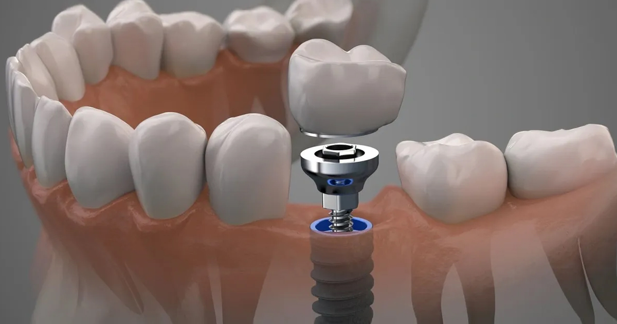 Dental Implant Instruments: The Key to Precision and Success