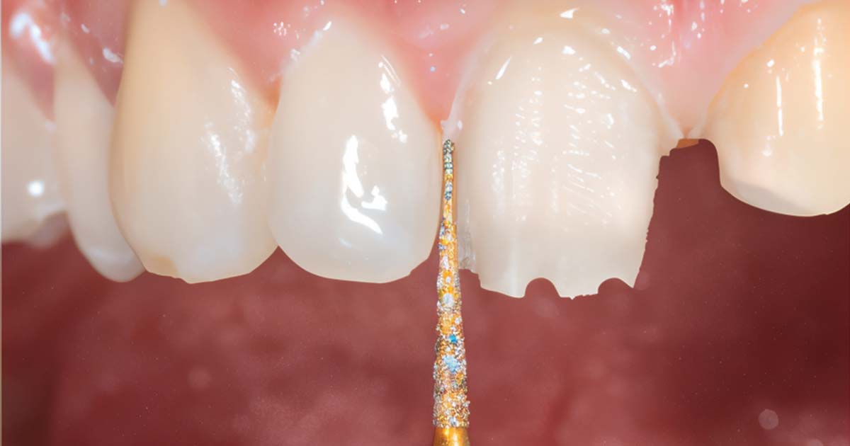 Tooth Preparation: A Student's Guide for Full Coverage Dental Crown