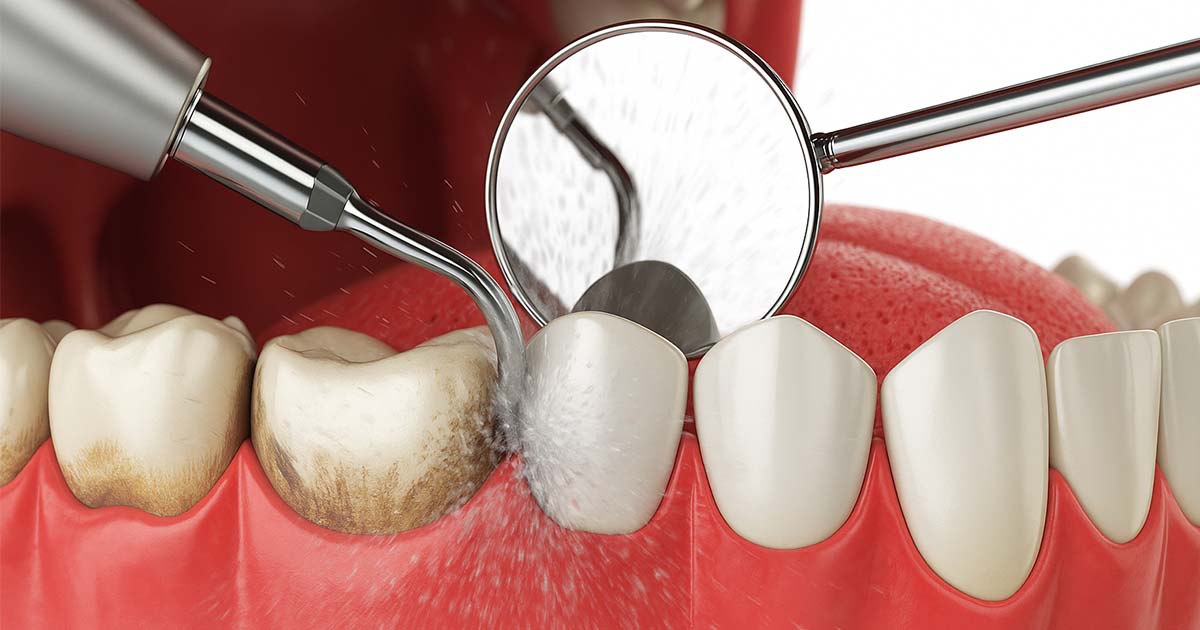 Tooth Scaling Truths Every Dentist Should Share with Patients