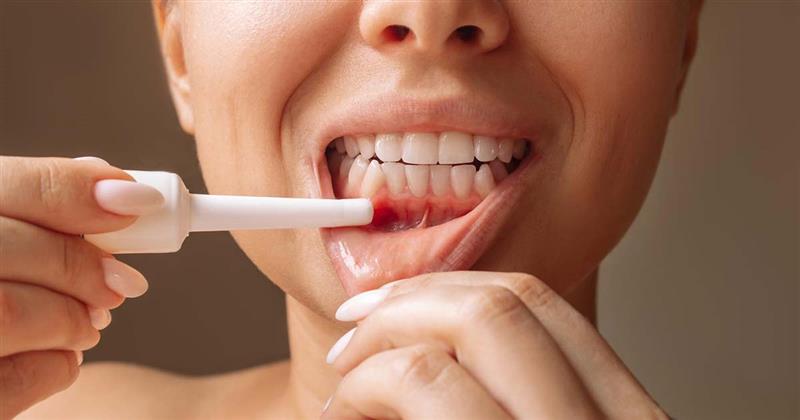 What Is Mouth Ulcer Gel and How Is It Used? – A Dentist's Guide 