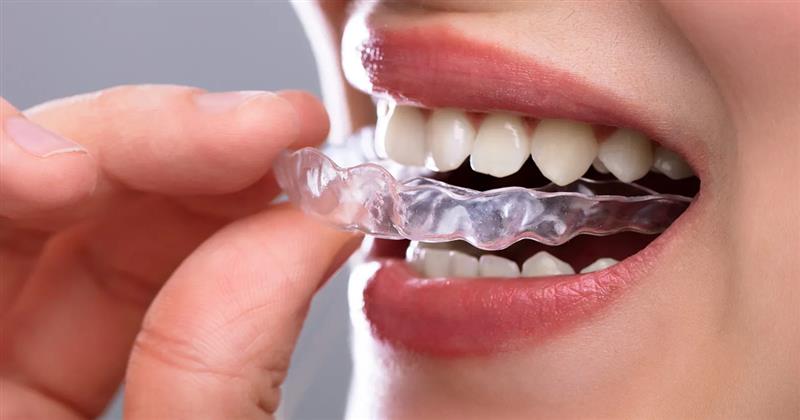 How to Set Up an In-House Clear Aligner System: Complete Guide for Orthodontists