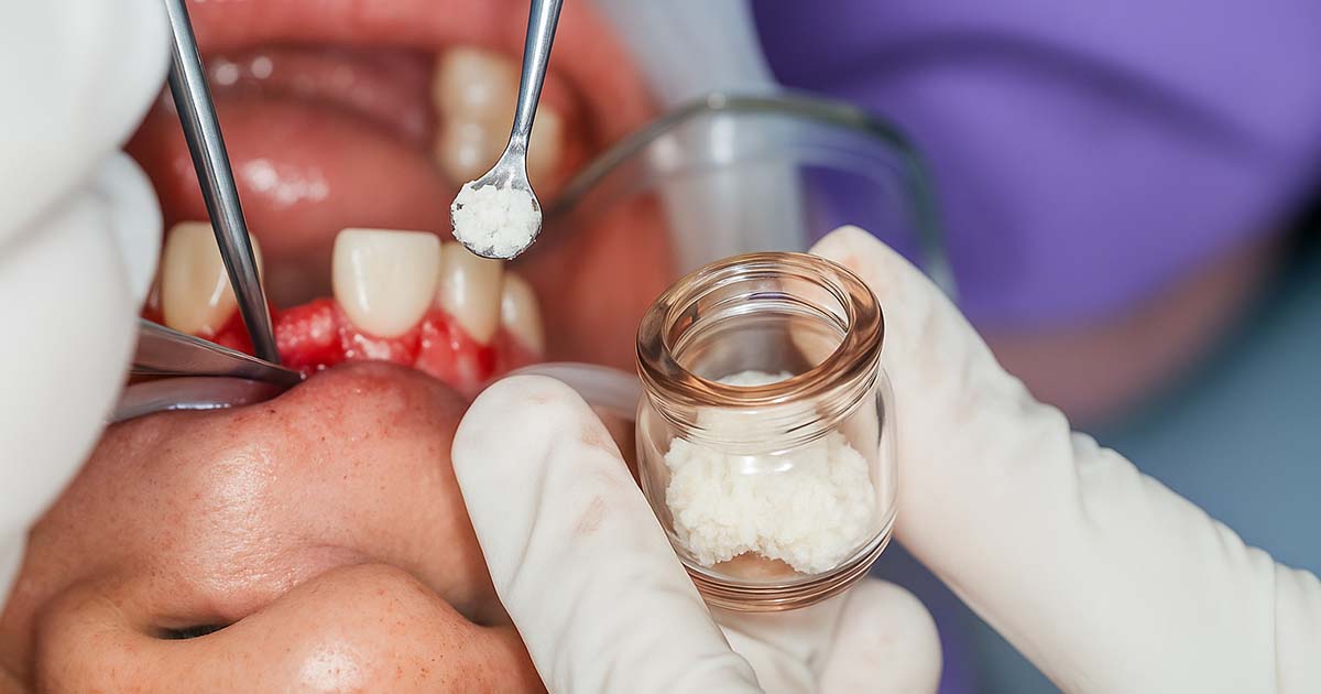 Bone Grafts and Membranes: Everything Dentists Need to Know
