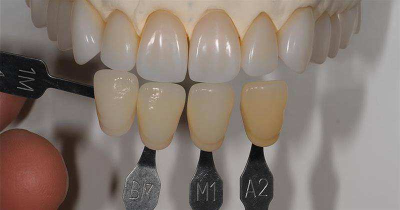 Best Practices for Shade Matching in Dentistry