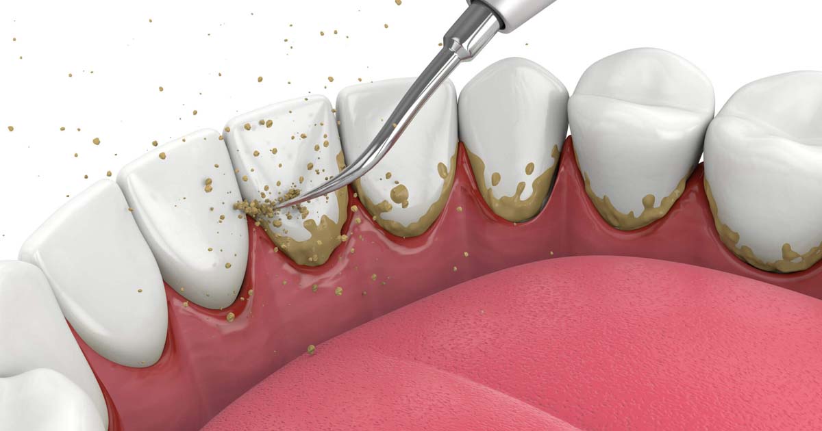 Non-Surgical Periodontal Therapy: A Complete Beginner’s Guide to Gum Disease Treatment 