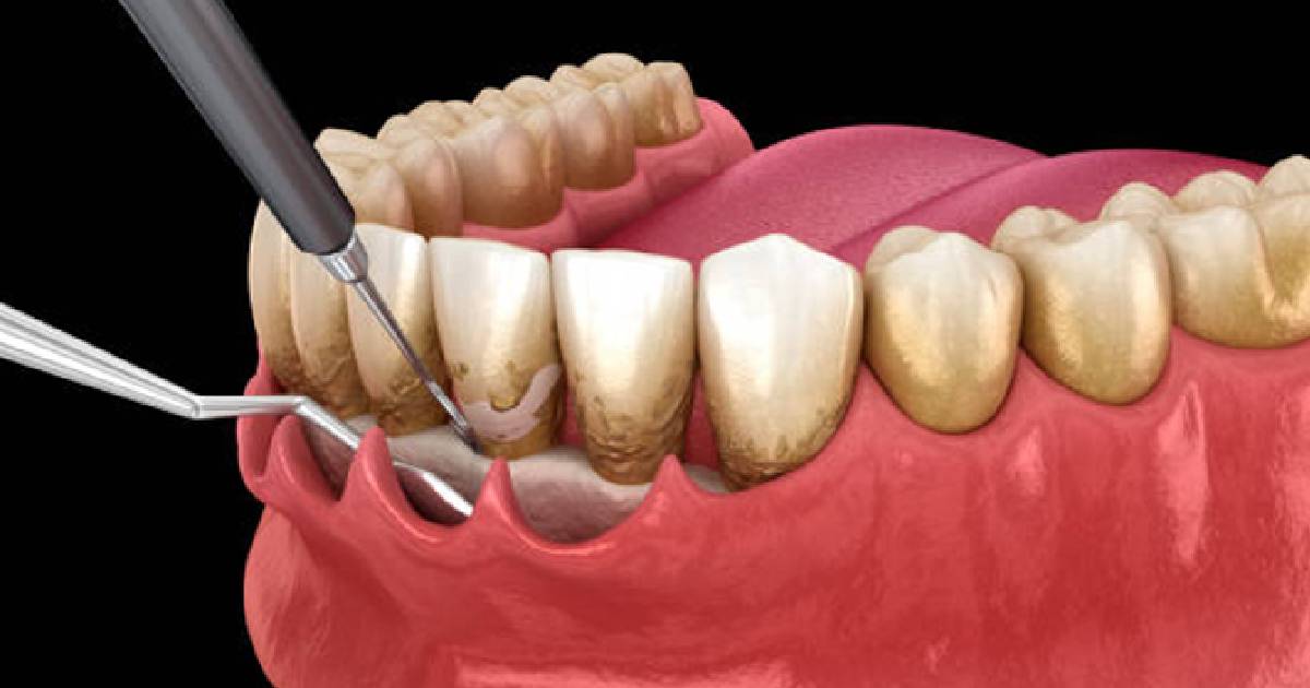 The Ultimate Dentist’s Guide to Surgical Periodontal Therapy  