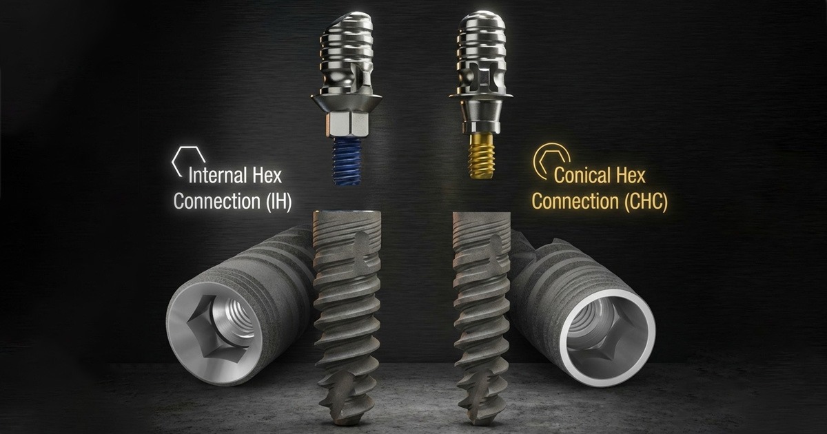 Internal Hex vs Conical Implant Connections: A Clinical Guide