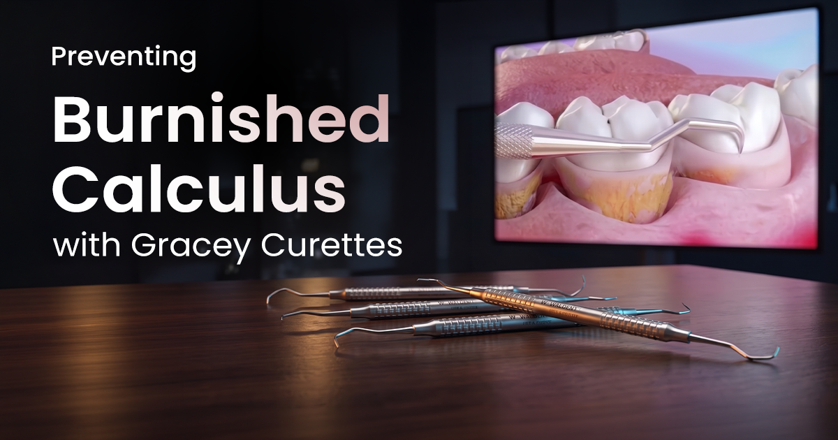 Preventing Burnished Calculus with Gracey Curettes