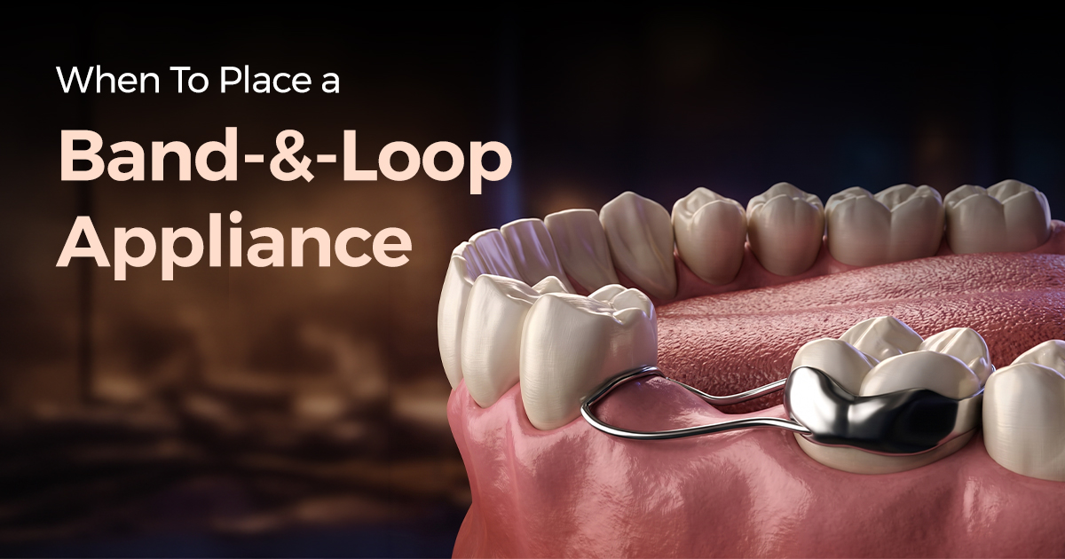 When To Place a Band-and-Loop Appliance