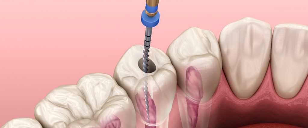 5 Best Endo Rotary Files