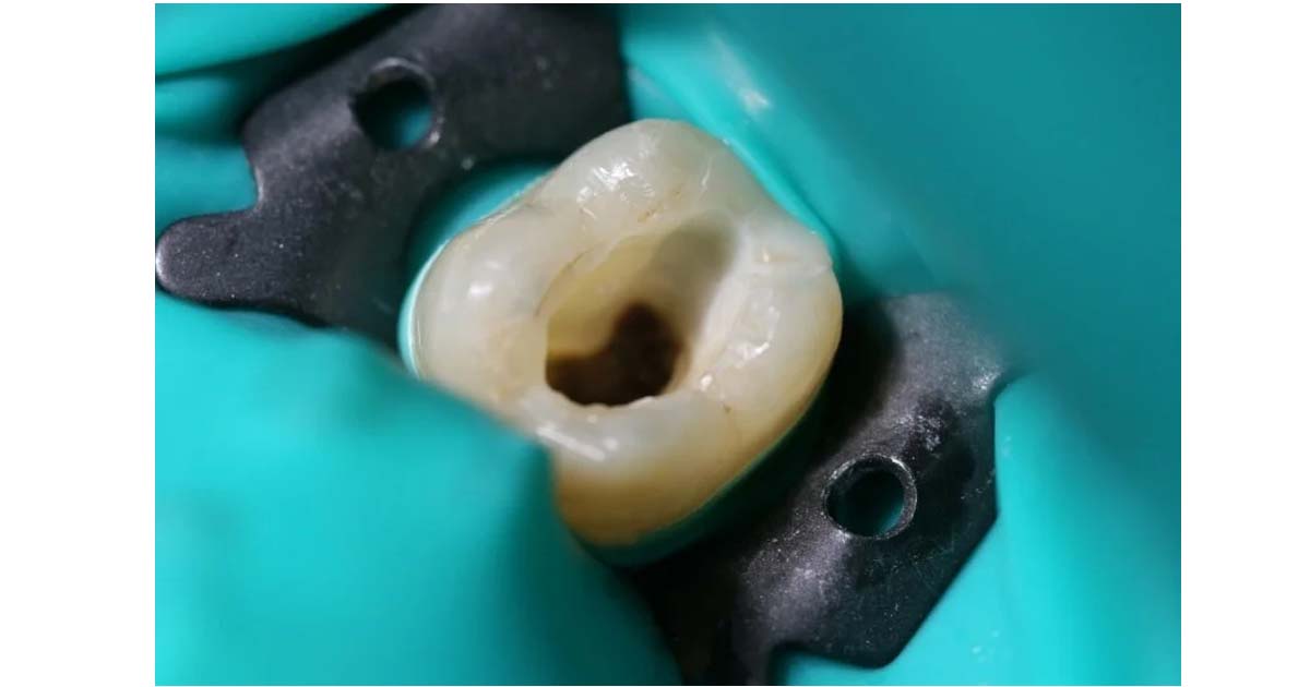 Common Errors during Root Canal Treatment
