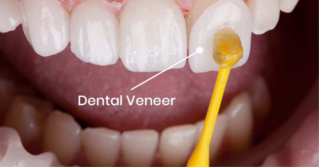 Veneers vs Crowns: What's the Difference?