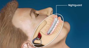 Night Guard for Teeth Grinding Patients in Dentistry