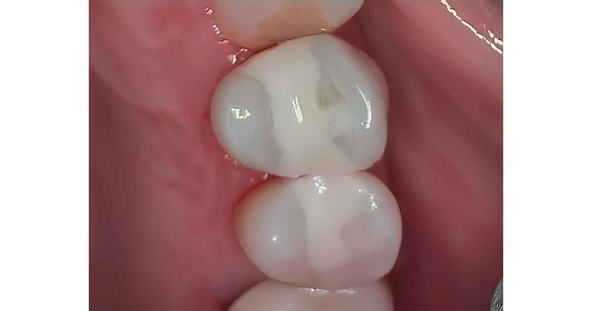 GIC vs Composite: Tooth-Colored Restorations