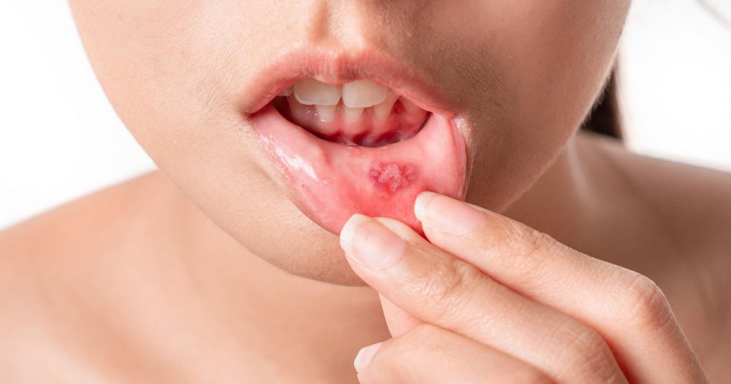 What Is Mouth Ulcer Gel and How Is It Used? – A Dentist's Guide 