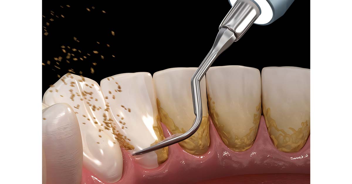 Tooth Scaling Truths Every Dentist Should Share with Patients