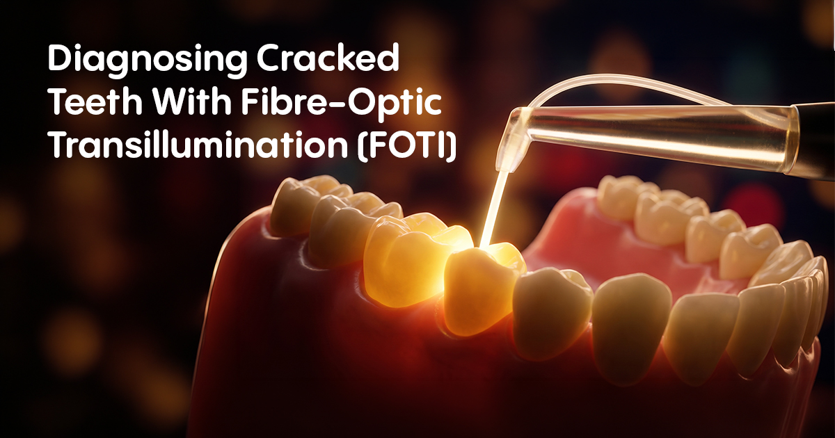 Diagnosing Cracked Teeth With Fibre-Optic Transillumination