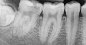 Digital Radiography in Dentistry