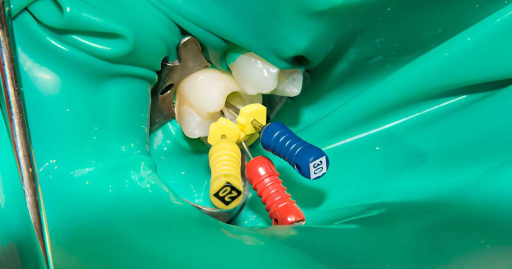 Difference Between K-File and H-File in Dentistry: All You Need to Know