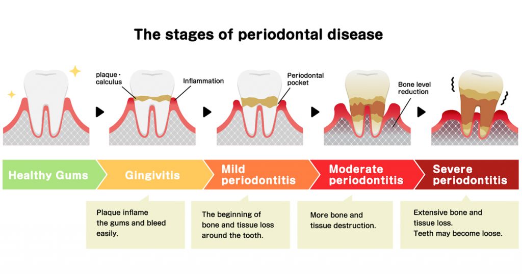 Non-Surgical Periodontal Therapy: A Complete Beginner’s Guide to Gum Disease Treatment