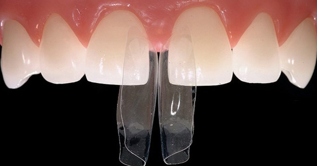 Step-by-Step Protocols for Minimally Invasive Cosmetic Dentistry (No-Prep Veneers & More)